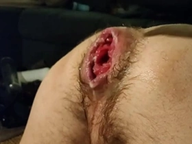 Just fisting my loose hole and prolapse:)